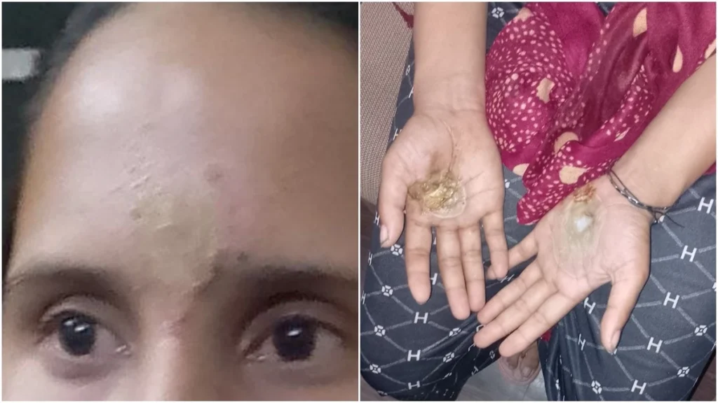 burn woman's hands