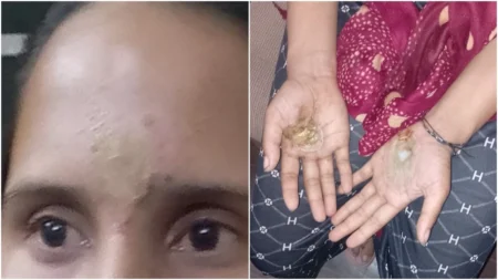 burn woman's hands